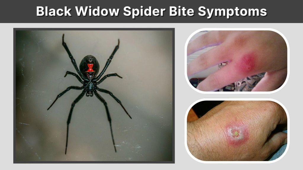 Black Widow Spider Bite Symptoms