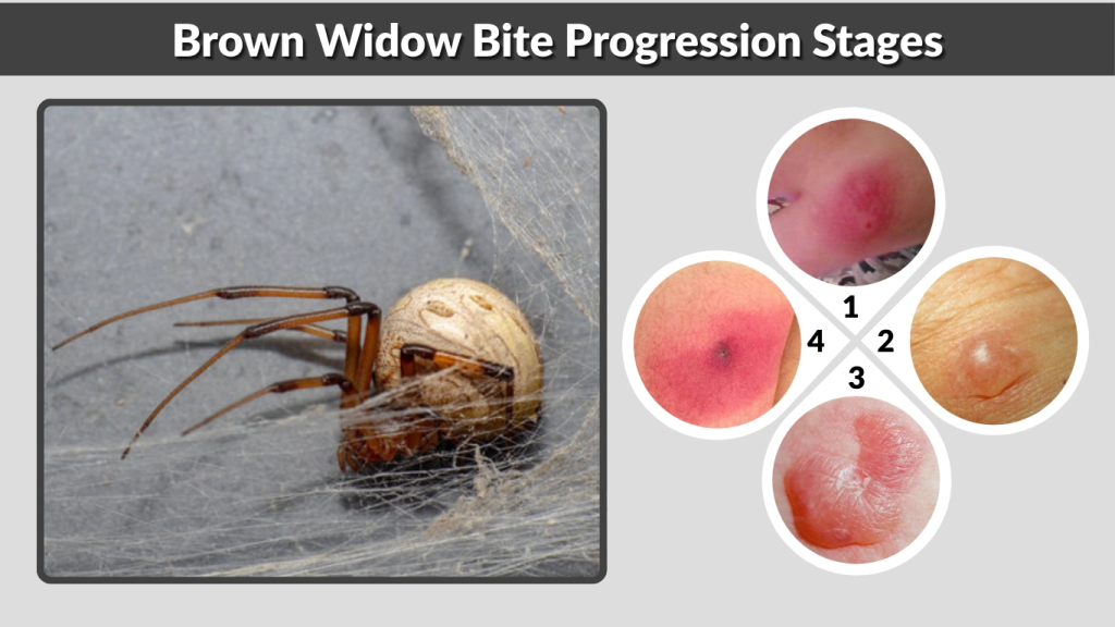 Brown Widow Bite Progression Stages