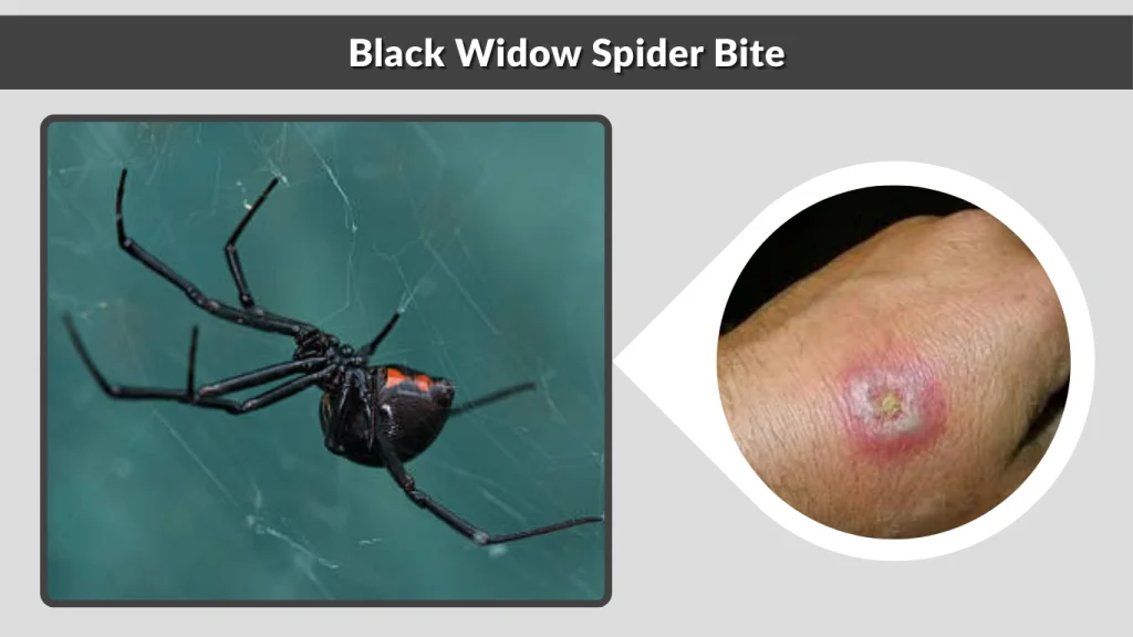 Black Widow Spider Bite
