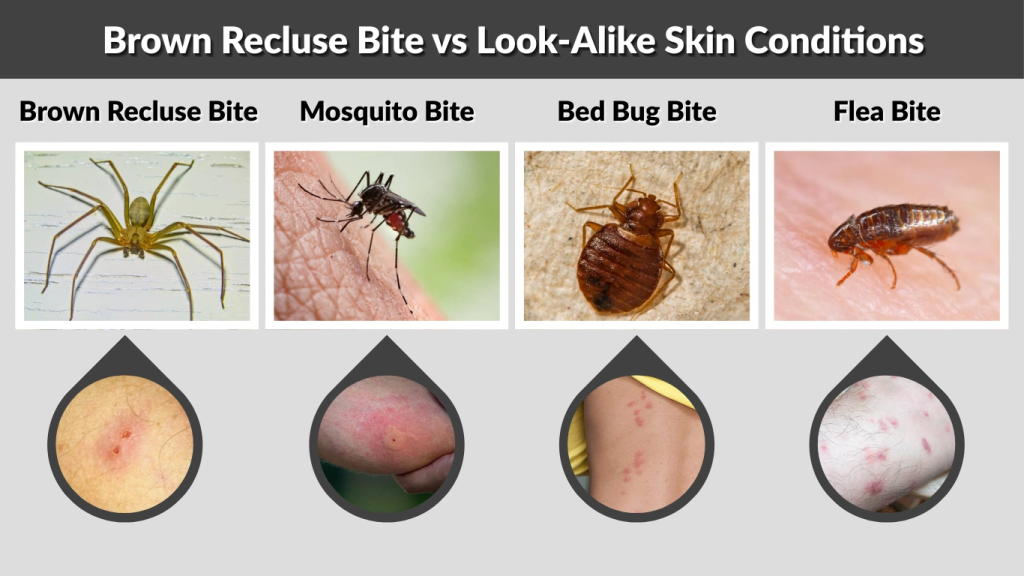 Recluse R64 What Does a Brown Recluse Spider Bite Look Like?