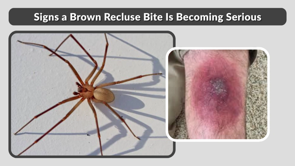Signs a Brown Recluse Bite Is Becoming Serious