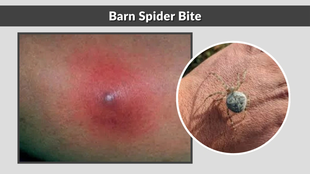 Barn Spider Bite