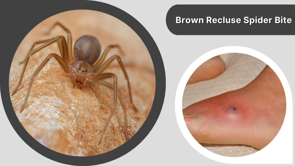 Brown Recluse Spider Bite