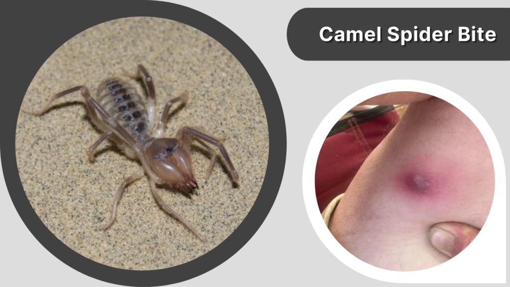 Camel Spider Bite