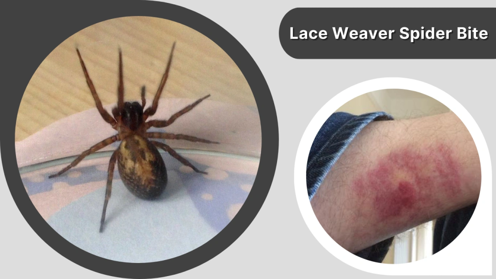 Lace Weaver Spider Bite