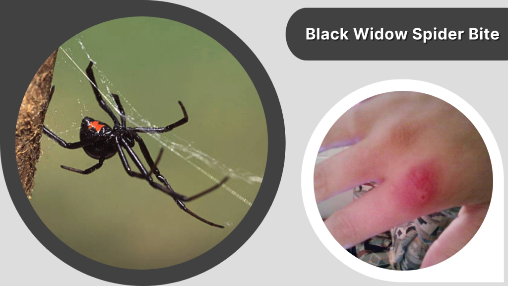 Black Widow Spider Bite