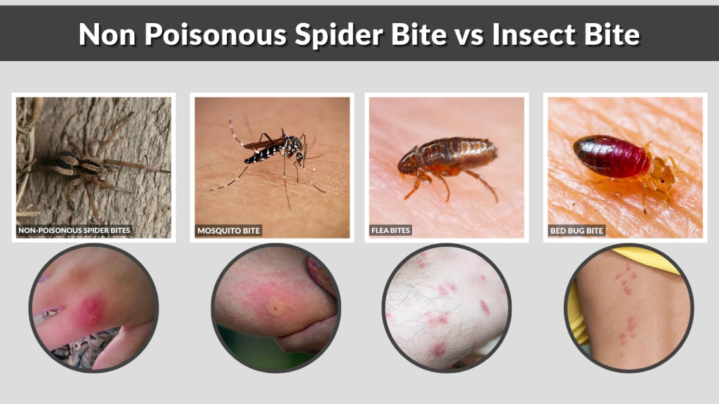 Non Poisonous Spider Bite vs Insect Bite