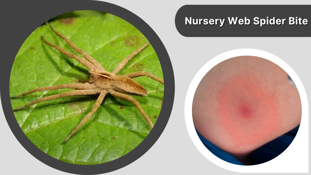 Nursery Web Spider Bite