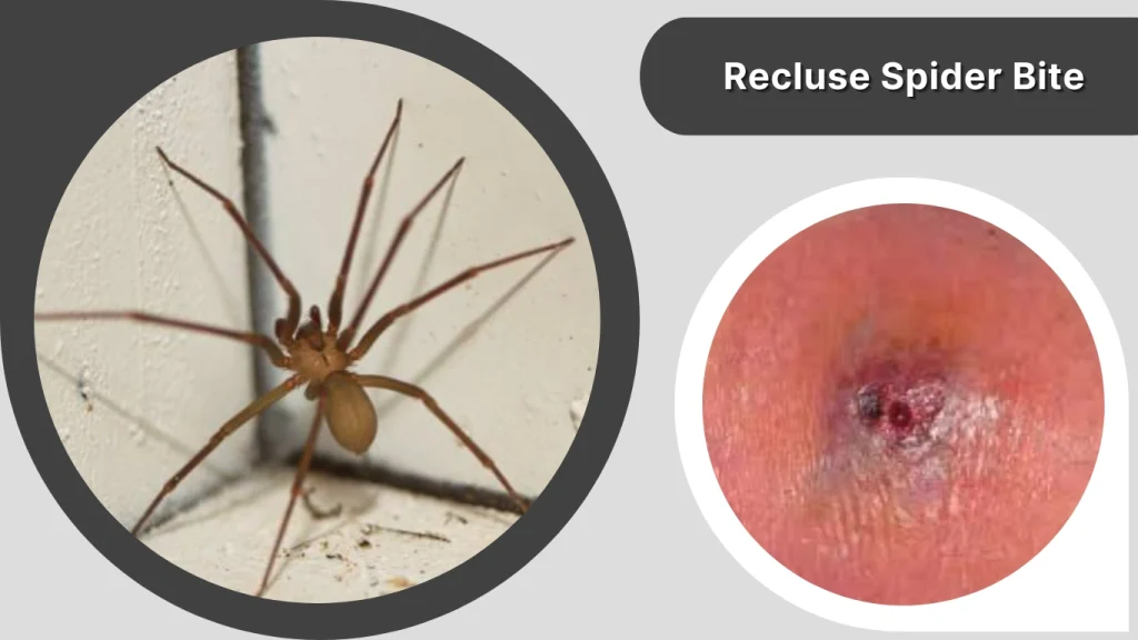 Recluse Spider Bite