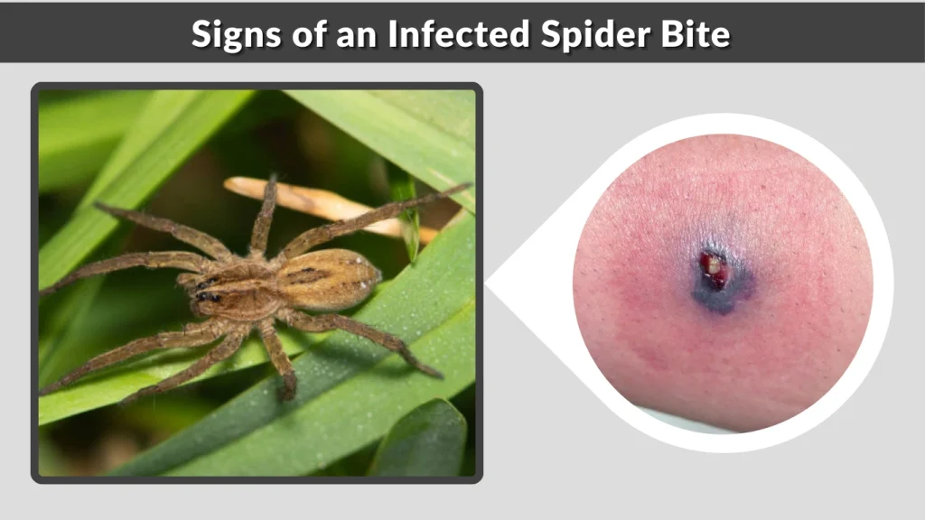 Signs of an Infected Spider Bite
