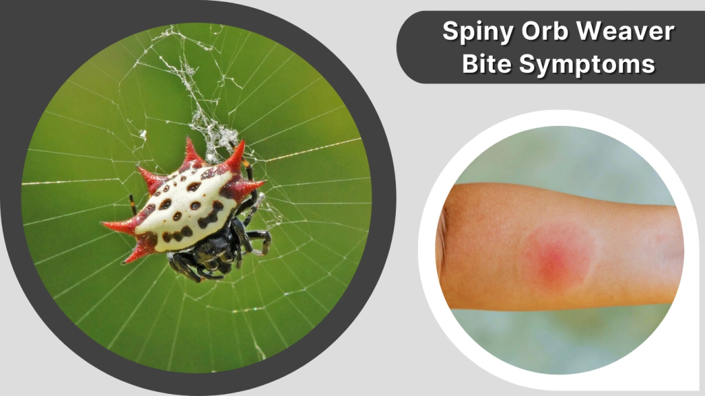 Spiny Orb Weaver Bite Symptoms