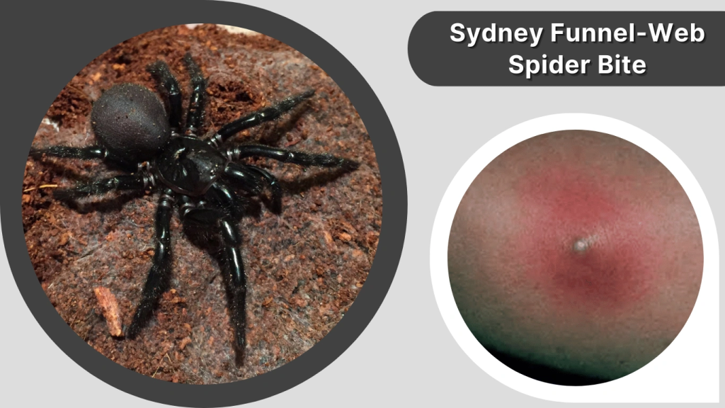 Sydney Funnel-Web Spider Bite