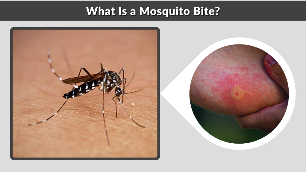 What Is a Mosquito Bite