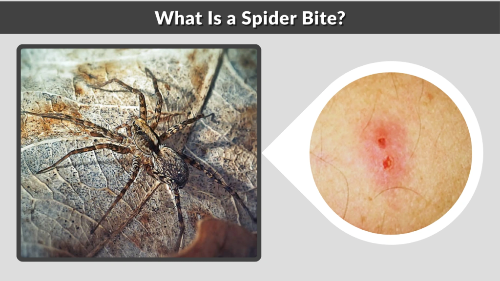 What Is a Spider Bite