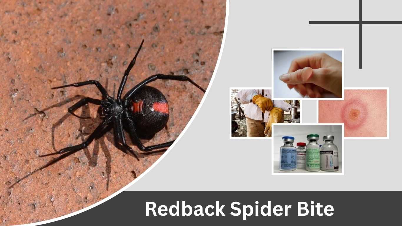 Redback Spider Bite Symptoms, Treatment and Facts