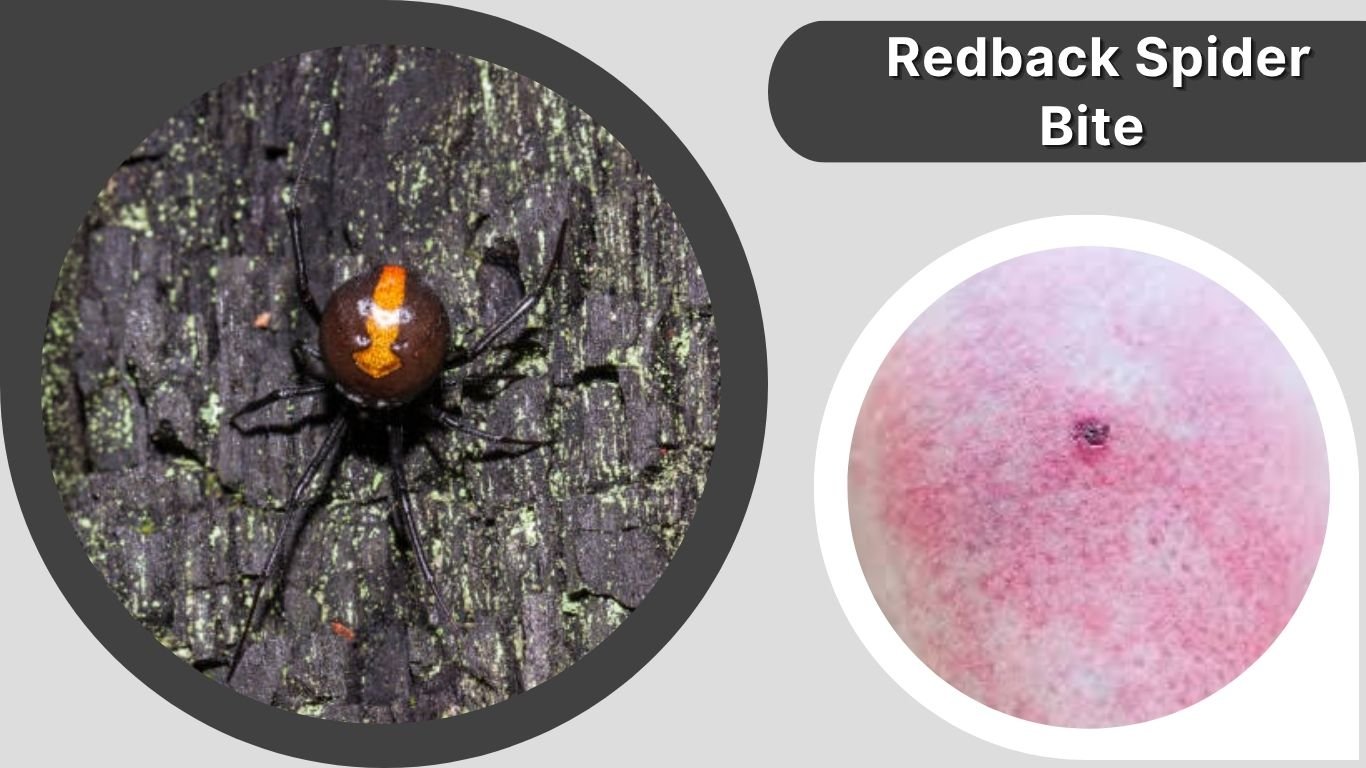 Spider Bite Raspberry Like 30 Types of Spider Bites: Symptoms, Risks & Treatment Guide