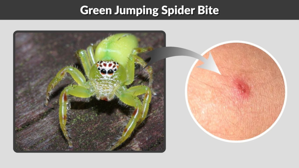 Green Jumping Spider Bite