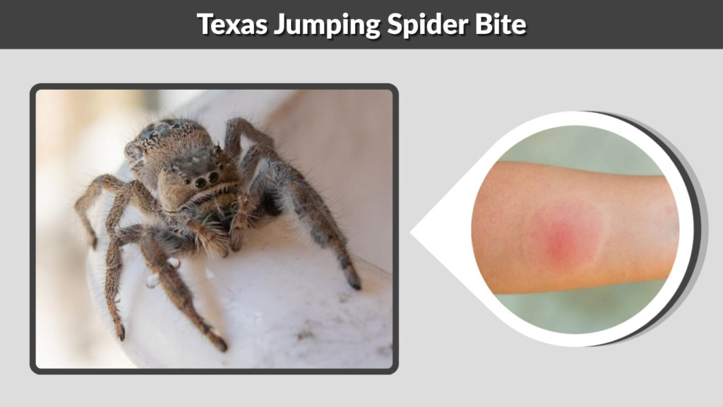 Texas Jumping Spider Bite