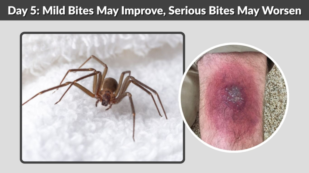 Day 5: Mild Bites May Improve, Serious Bites May Worsen