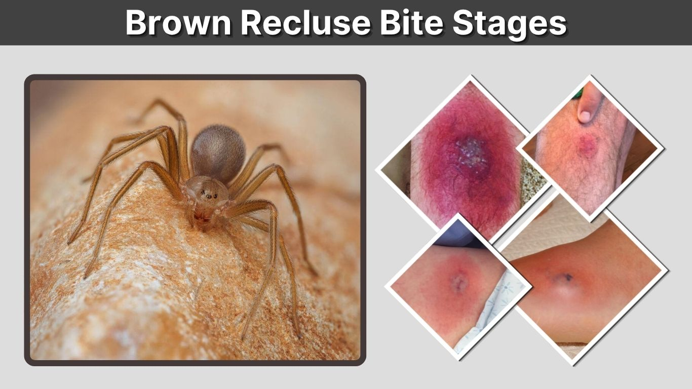 Brown Recluse Bite Stages: Day 1 to Day 7 Symptoms and Care