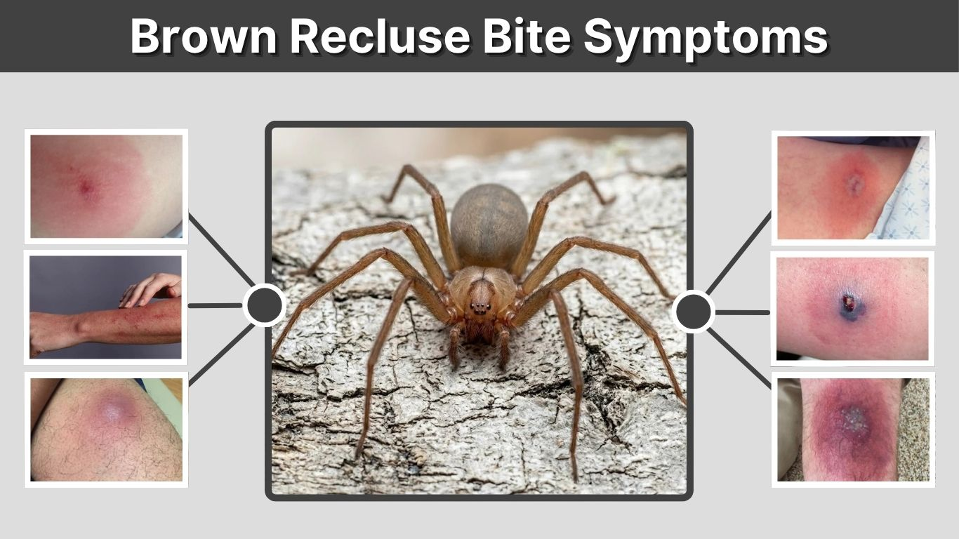 Brown Recluse Bite Symptoms: 13 Common Signs to Know