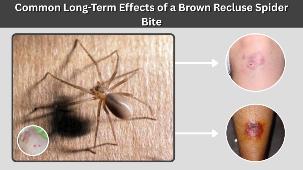 Common Long-Term Effects of a Brown Recluse Spider Bite