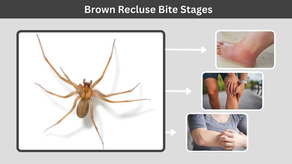 Brown Recluse Bite Stages