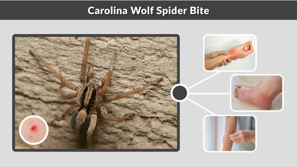 Carolina Wolf Spider Bite