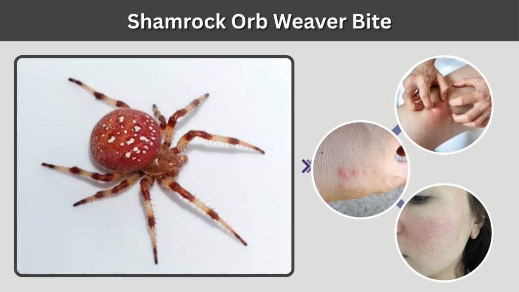 Shamrock Orb Weaver Bite