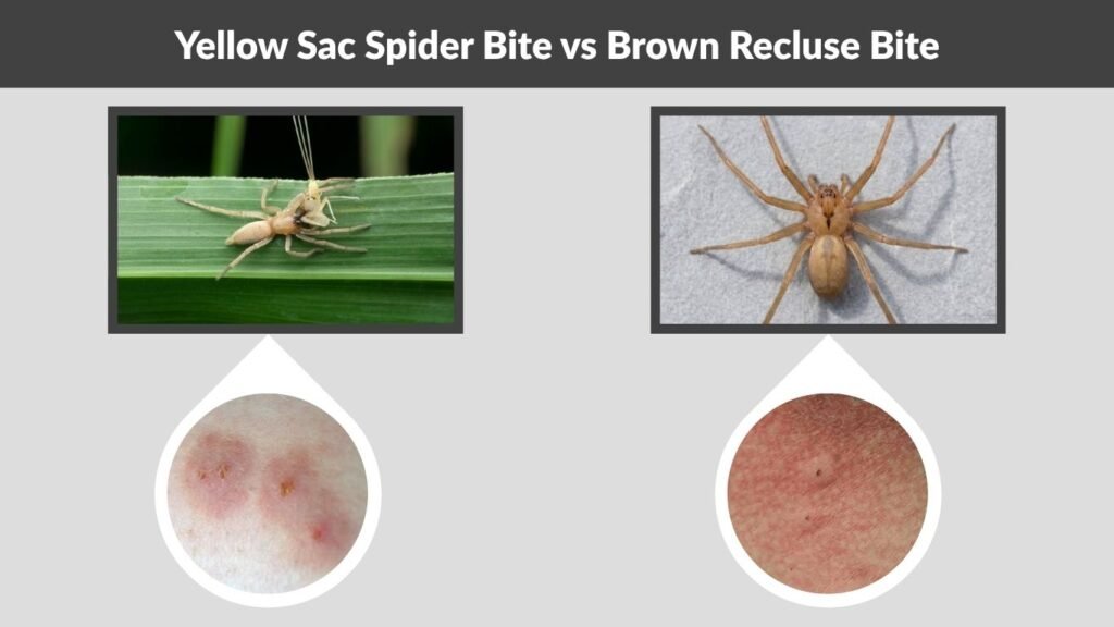 Yellow Sac Spider Bite vs Brown Recluse Bite